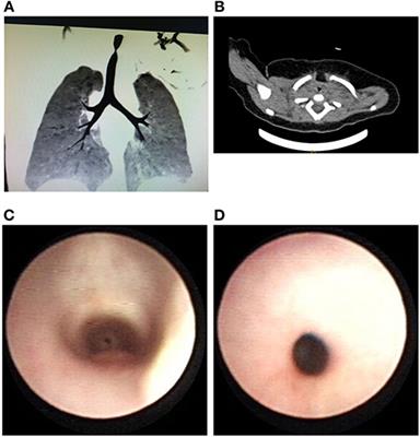 Clinical Analysis of Congenital Deficient Tracheal Cartilage Rings: Six Case Reports and a Literature Review